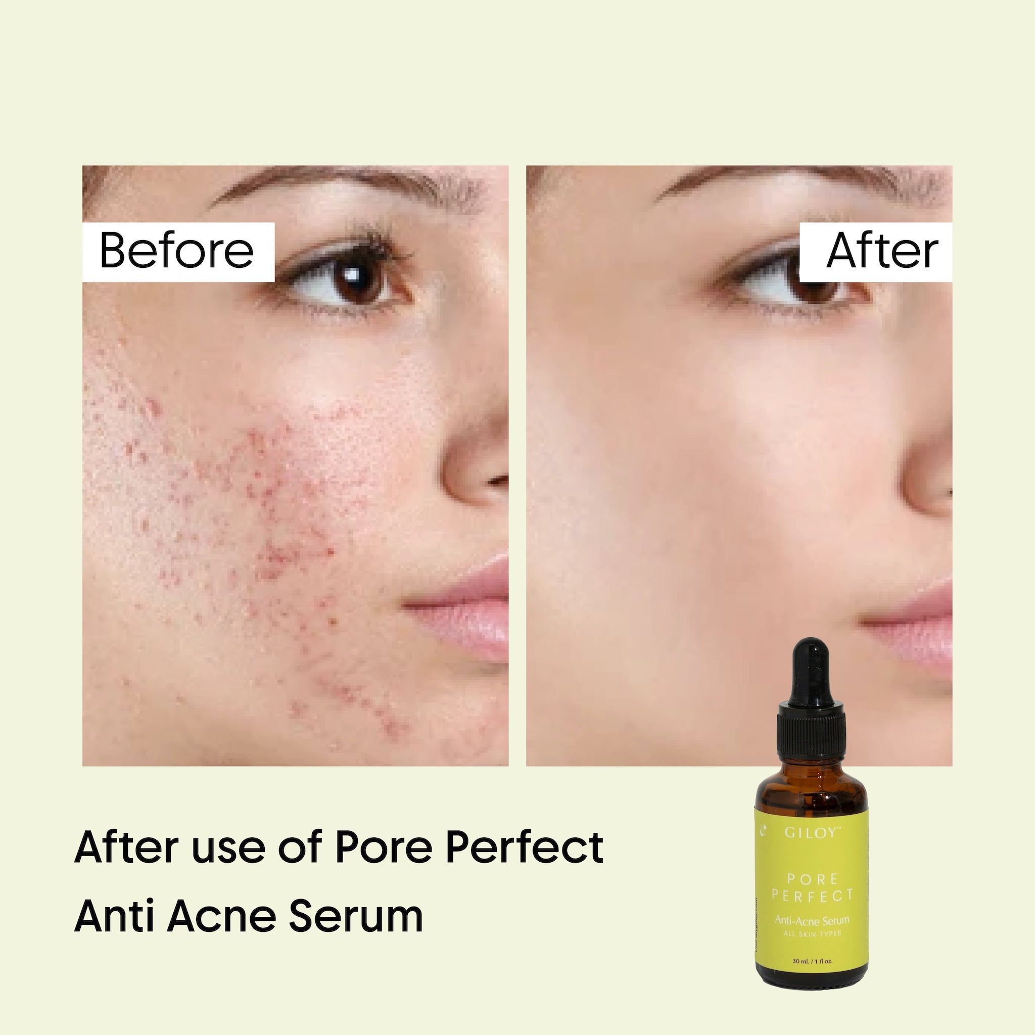 Pore Perfect Anti-Acne Serum
